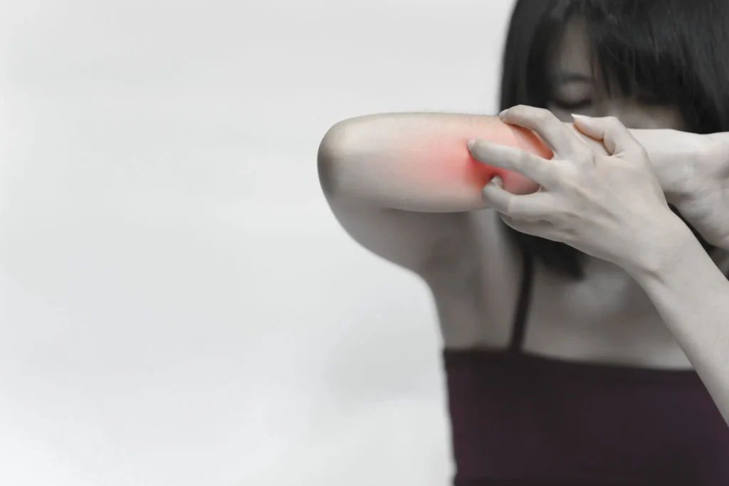 red marks woman s arm that itches from allergy insect bite scaled.jpg